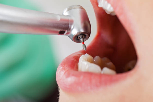 Best Emergency Wisdom Teeth Removal in Carey, ID